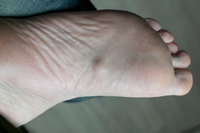 Definition and Phases of Plantar Fibromatosis