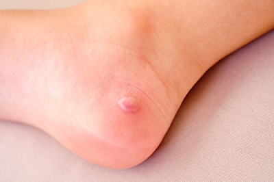 Recognizing Signs of an Infected Foot Blister