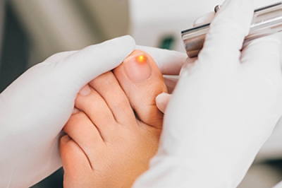 A Guide to Laser Treatment for Fungal Toenails